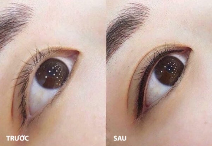 Phun mí mở tròng có hại không?